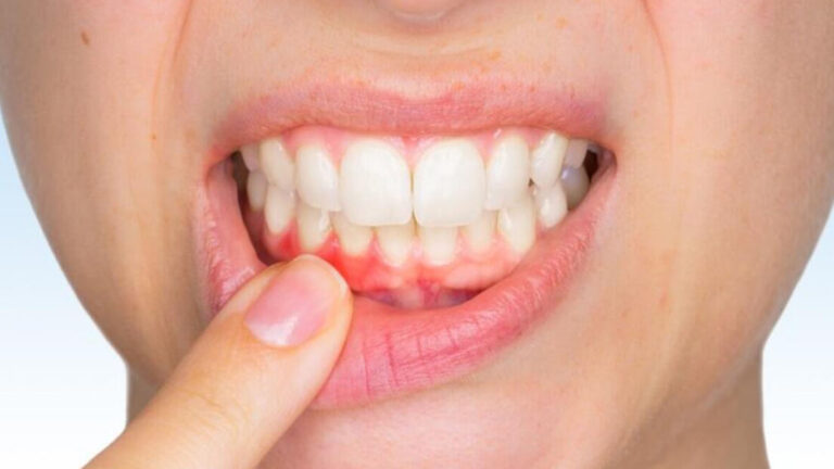 Dişeti çekilmesi neden olur? Dişeti Çekilmesi Nasıl tedavi edilir